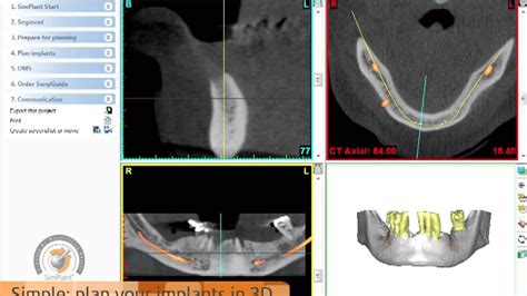 Guided Implant Surgery Dmd Shahnavaz Straumann Youtube