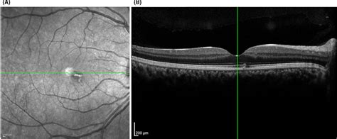 Acute Macular Neuroretinopathy Associated With Covid‐19 A Infrared