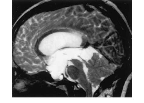 Sagittal T 2 Weighted Magnetic Resonance Image Showing The Features Of