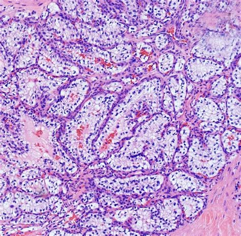 Scielo Brasil Papillary Cystadenoma Of The Epididymis Papillary Cystadenoma Of The Epididymis