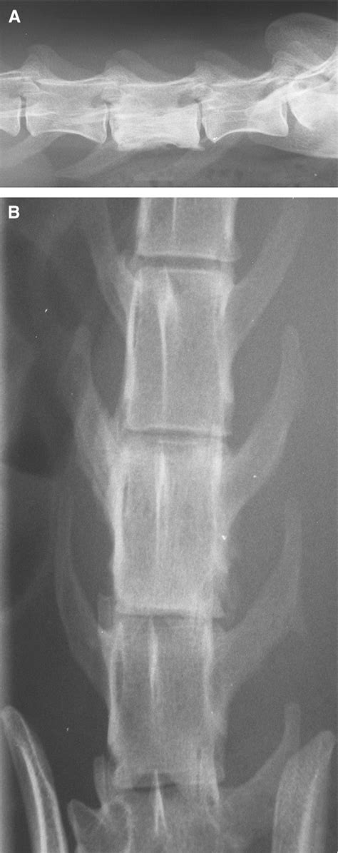 Figure From Solitary Plasmacytoma Of Bone In Two Successfully Treated