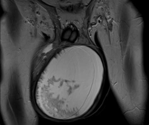 Testicular Rupture Image Radiopaedia Org