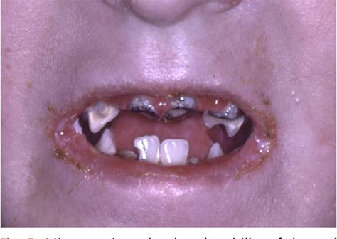 Oral Manifestations In The Epidermolysis Bullosa Spectrum Semantic