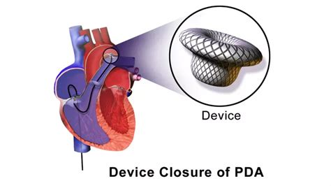 Ductus Arteriosus Closure Dovemed