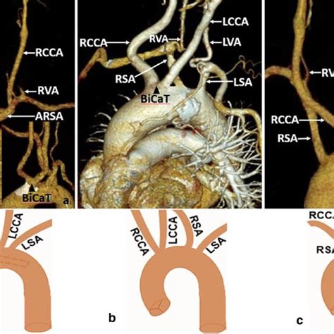 Anterior View Of The Right Sided Aortic Arch Raa Branching Pattern A Download Scientific