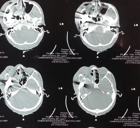 A CT head and orbit showing a large metallic body in the right temporal ...