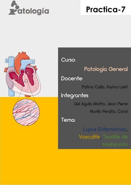 Lupus Eritematoso Vasculitis Tioiditis De Hashimoto ALTRUUS UDocz