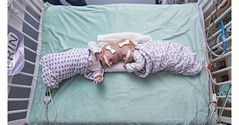 Formerly Conjoined Twins Erin And Abby Delaney Thriving Months After Separation Surgery At