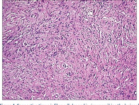 Figure 1 From Solitary Neurofibroma Of The Gingiva A Rare Case Report