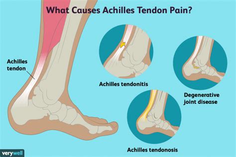 Achilles Tendon Pain Causes, Treatment, And When To See A Doctor | Best Diagram Collection