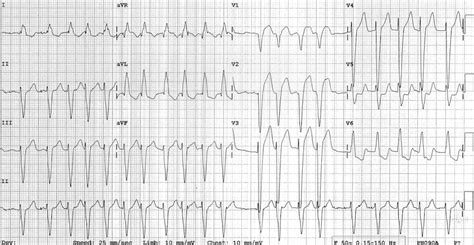 Dilated Cardiomyopathy Dcm Litfl Ecg Library Diagnosis 73980 Hot Sex