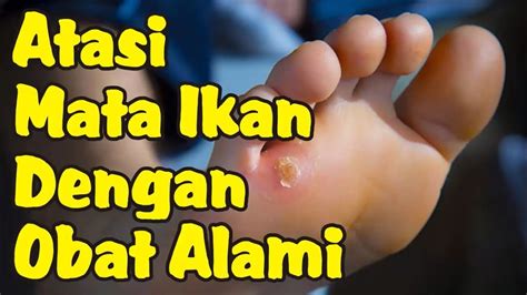 Obat Alami Untuk Mengatasi Mata Ikan Youtube