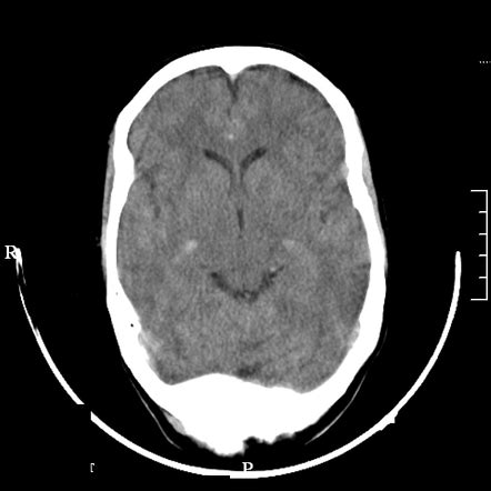 Skull Vault Hemangioma Image Radiopaedia Org