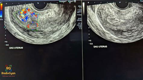 Retained Products Of Conception Radiology Case Radiogyan