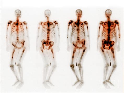 Bone Scan Showing Multiple Metastases #2 Photograph by Scott Camazine ...