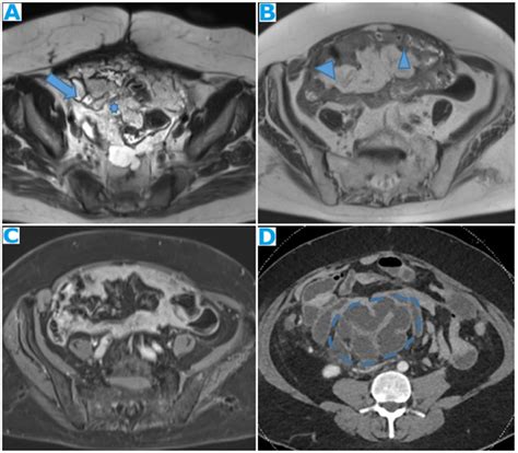 Axial T2wi A Pc From Mucinous Adenocarcinoma Of The Uracus Notice