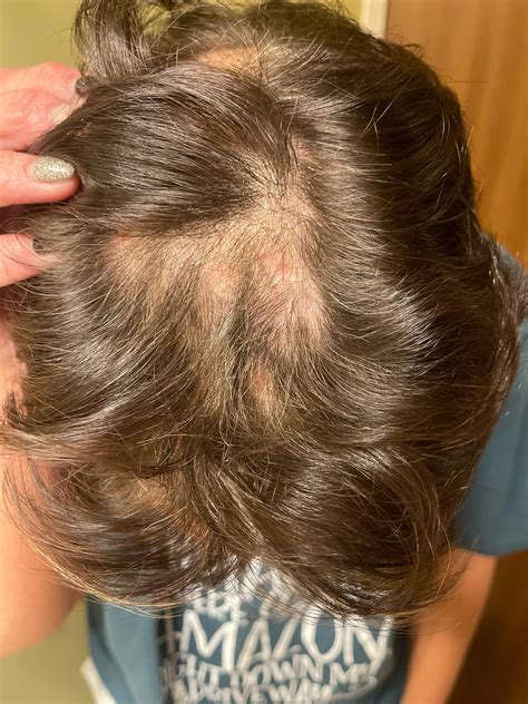 Atopic Dermatitis Scalp Eczema R Eczema