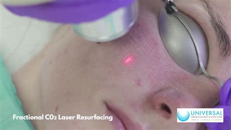 Fractional Co2 Laser Resurfacing Youtube