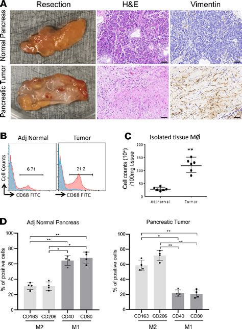 Characterization Of Pancreatic Ductal Adenocarcinoma A Download