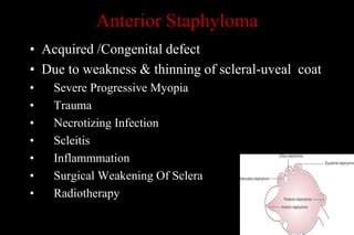 Staphyloma | PPT