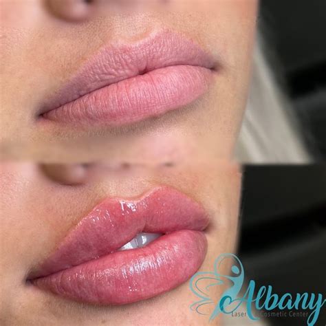 Lip Fillers Case No 1369 Albany Cosmetic And Laser Centre In Edmonton