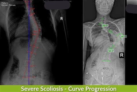 Severe Scoliosis Symptoms Treatment And Surgery