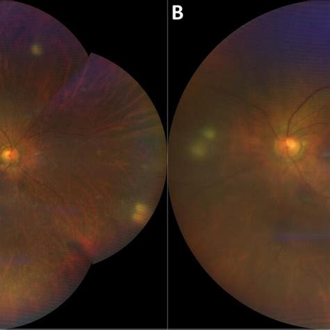 Color Fundus Photographs Of The Right A And Left B Eye Showing