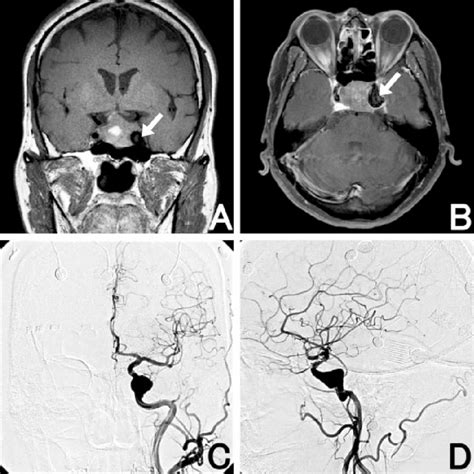 A B Magnetic Resonance Imaging Mri Shows An Intra And Suprasellar