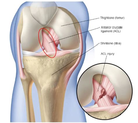 Les O Do Ligamento Cruzado Anterior Dr Victor Salas