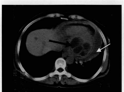 Figure From An Unusual Primary Left Ventricular Hydatid Cyst