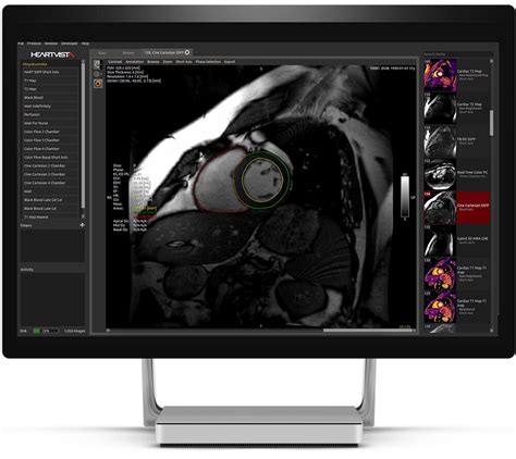 Ai Software Shortens Cardiac Mr Scanning Time By 31