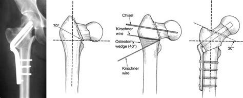 Femoral Neck Fractures Trauma Orthobullets