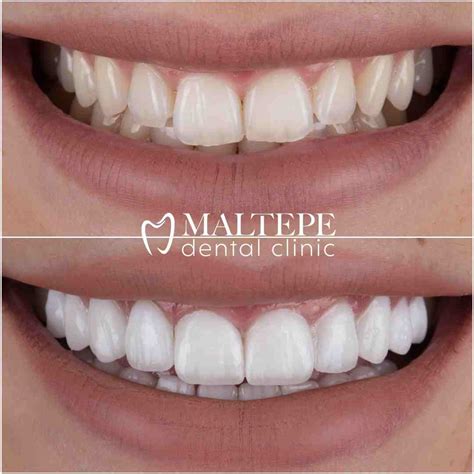 Veneers Vs Lumineers Which Option Is Better Maltepe Dental Clinic