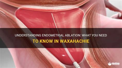 Understanding Endometrial Ablation What You Need To Know In Waxahachie Medshun