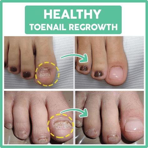 How To Help A Toenail Grow Back Quickly Steps With Pictures Artofit