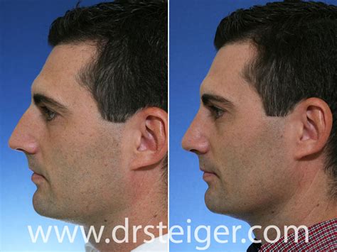 Male Celebrity Rhinoplasty Before And After