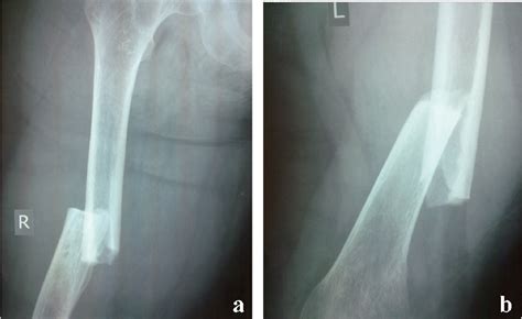 Figure 1 From Simultaneous Bilateral Atypical Femoral Fractures After