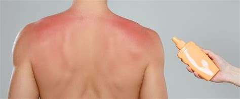 How Can I Avoid Getting Sunburned This Year Afc Urgent Care Hixson Blog