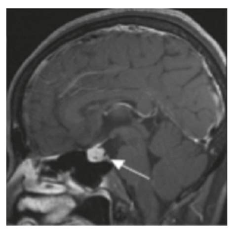 Dynamic Magnetic Resonance Imaging Mri Of The Pituitary Download