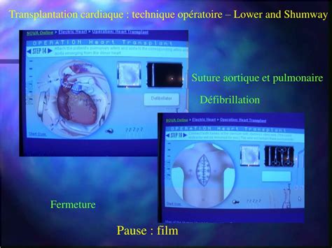 Ppt La Transplantation Cardiaque Powerpoint Presentation Free