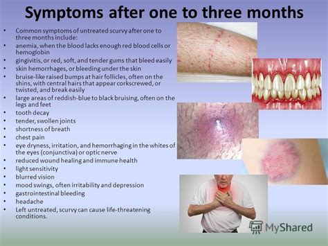 Scurvy Symptoms And Causes