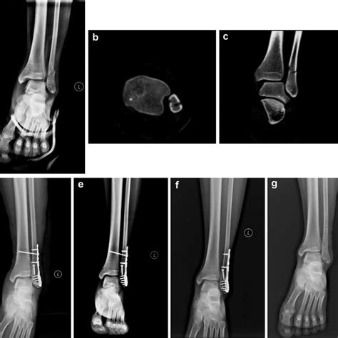 A Male Patient Diagnosed With Weber Type C Laugehansen Per Iv