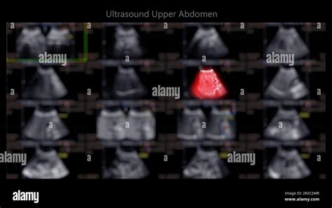 Ecograf A Del Abdomen Superior Que Muestra El H Gado Y La Ves Cula