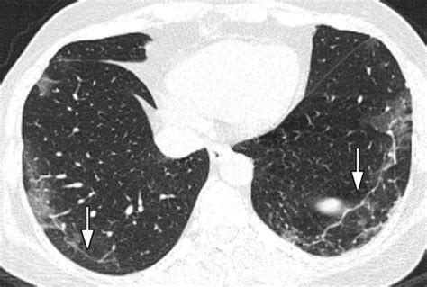 Implications Of Sex Difference In Ct Scan Findings And Outcome Of