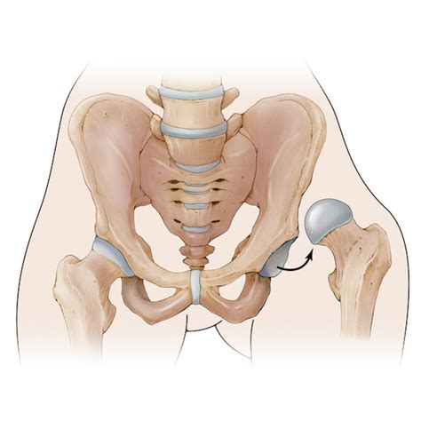 Canadian Limb Lengthening Center | Surgical hip dislocation