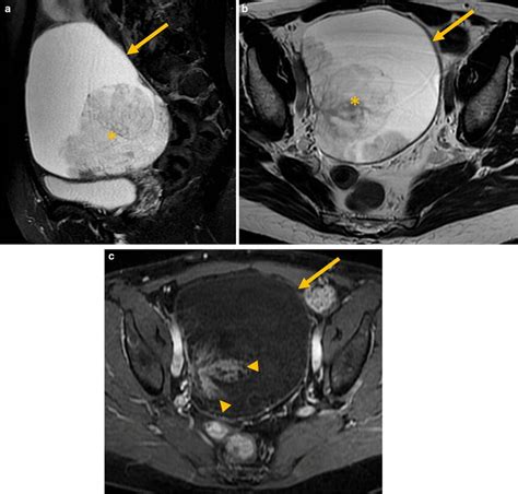 Sagittal And Axial T2wi And Arterial Dynamic Contrast Enhanced Axial