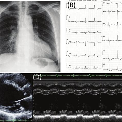 A Chest X Ray An Electrocardiogram And A Transthoracic Echocardiogram