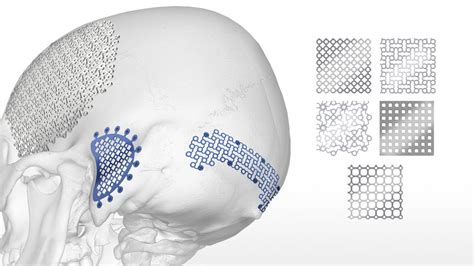 Osteomed Osteoform Cranial Mesh Acumed