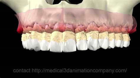 Periodontal Disease Periodontitis 3d Medical Animation Company Studio