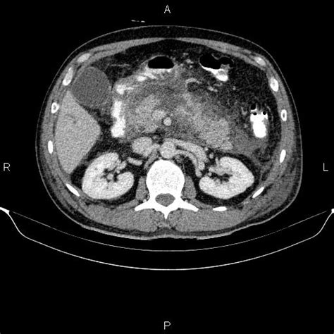 Necrotizing Pancreatitis Image Radiopaedia Org